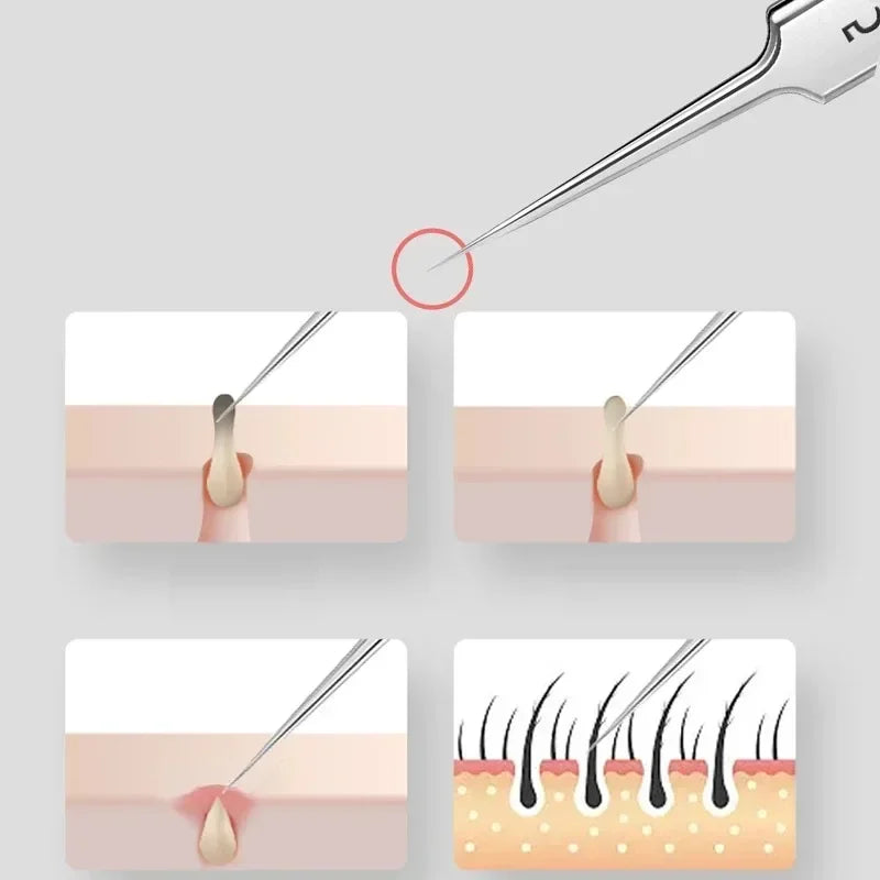 Gentle Blackhead Remover Tool
